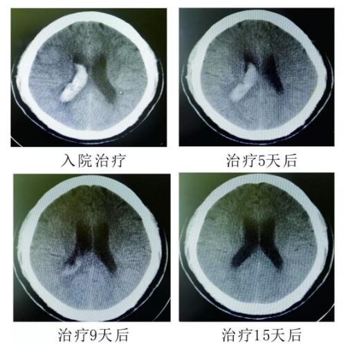 腦出血你不得不引起重視的疾?。。?！