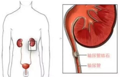輸尿管結石，到底能不能保守治療？