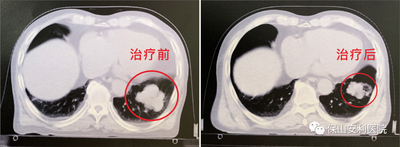 不做手術(shù)，早期肺癌也能根治！