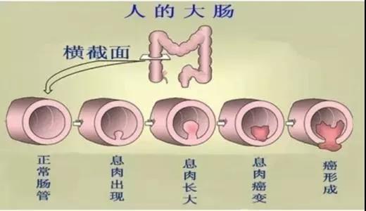 體檢發(fā)現(xiàn)腸息肉會(huì)癌變嗎？